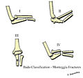 Bado Classification - Monteggia Fractures.jpg