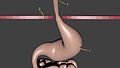 File:Hernia de hiato.ogv
