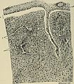 A treatise on the nervous diseases of children - for physicians and students (1895) (14784114865).jpg