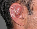 Serom Ear.jpg