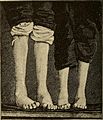 A treatise on the nervous diseases of children, for physicians and students (1905) (14781514981).jpg
