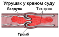 Blood clot diagram srpski.PNG